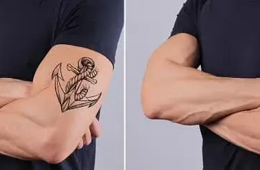 skin tag and mole remover